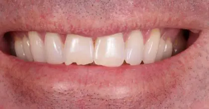 PA. before. invisalign, whitening, & bonding