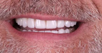 SE after, whitening, veneers + crowns