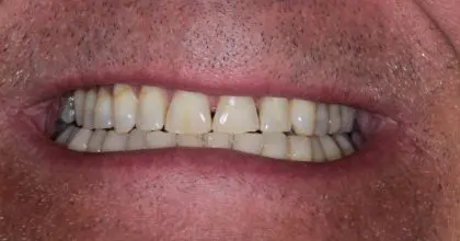 SE before, whitening, veneers + crowns