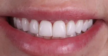 SG. After, whitening crown lengthening and 4 veneers