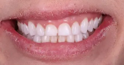 SG. Before, whitening crown lengthening and 4 veneers
