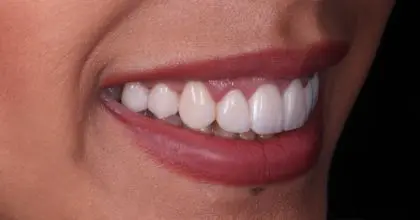 SR, after, orthodontics, whitening, crown lengthening and veneers