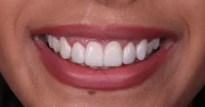 SR, after, orthodontics, whitening, crown lengthening and veneers