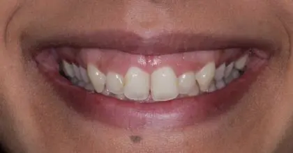 SR, before, orthodontics, whitening, crown lengthening and veneers