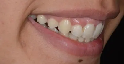 SR, before, side smile, orthodontics, whitening, crown lengthening and veneers