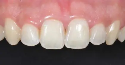 SR close up teeth before