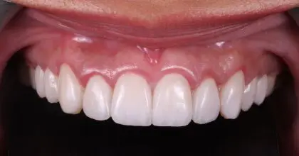 SR - Orthodontics, Whitening, Crown Lengthening & Veneers (Close Up)