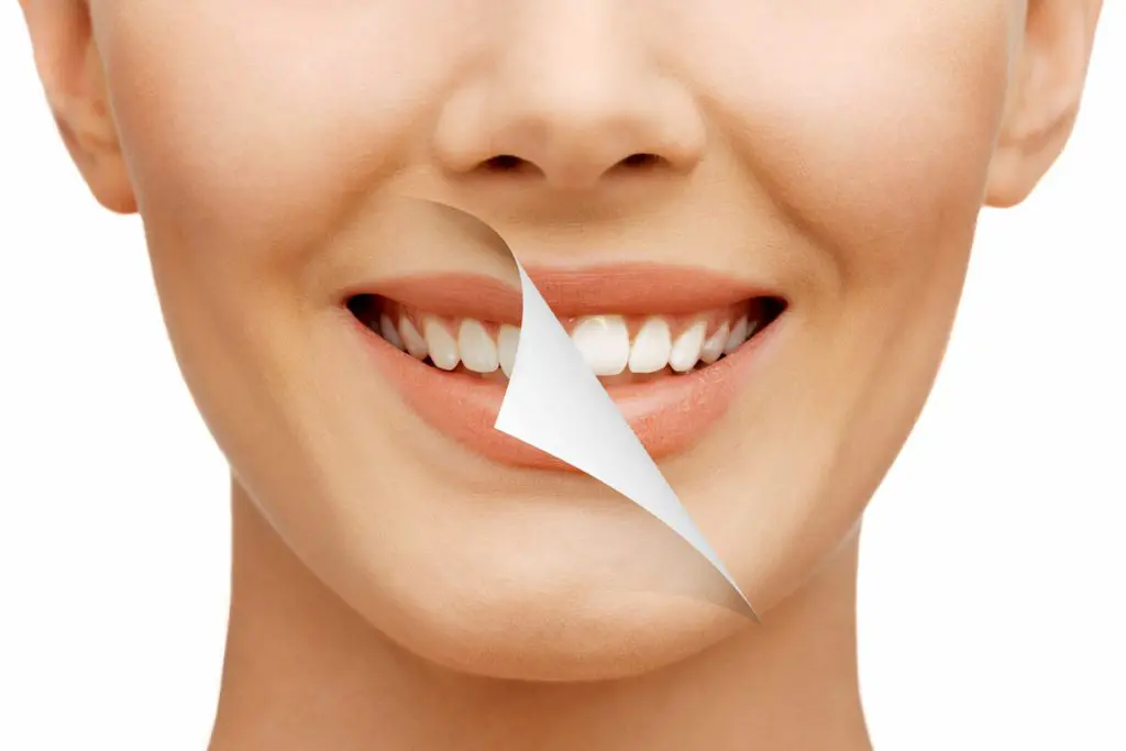 Veneers Orpington