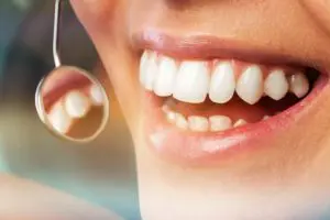 What Are Composite Fillings?