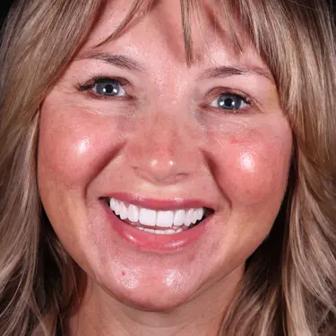 Vogue Dental - Signature Veneers