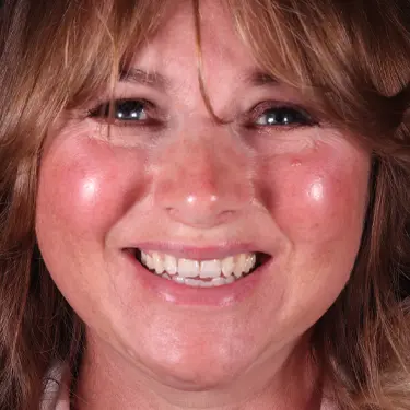 Vogue Dental - Signature Veneers