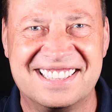 Vogue Dental - Signature Veneers