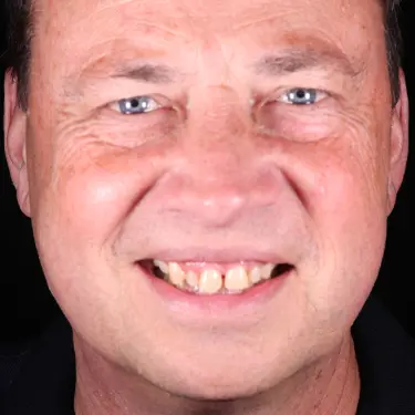 Vogue Dental - Signature Veneers