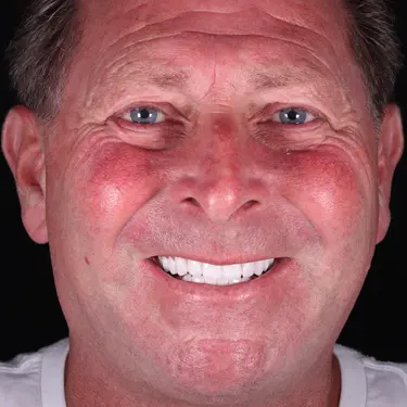 Vogue Dental - Signature Veneers