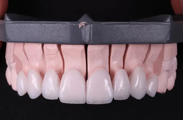 Vogue Dental - Signature Veneers