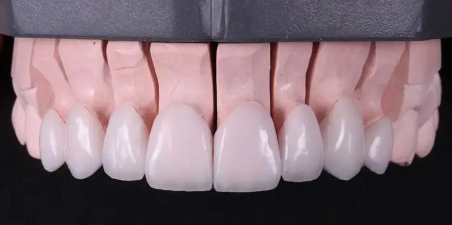 Vogue Dental - Porcelain Veneers Lumineers