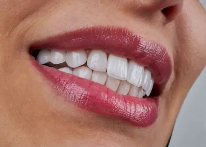 Vogue Dental - Composite Bonding In Chislehurst