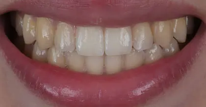 Vogue Dental - Teen Invisalign Case 1 After Smiling