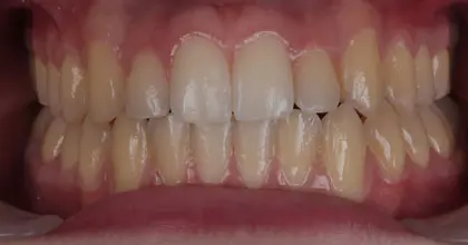 Vogue Dental - Teen Invisalign Case 1 After