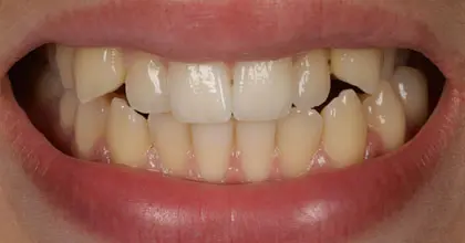 Vogue Dental - Teen Invisalign Case 1 Before Smiling