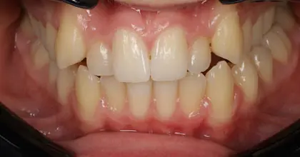 Vogue Dental - Teen Invisalign Case 1 Before