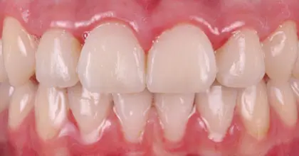 Vogue Dental - Teen Invisalign Case 2 After Retracted