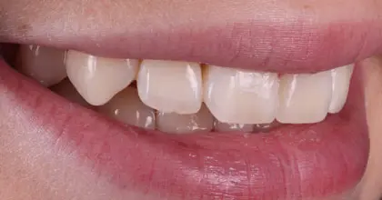Vogue Dental - Teen Invisalign Case 2 After Side
