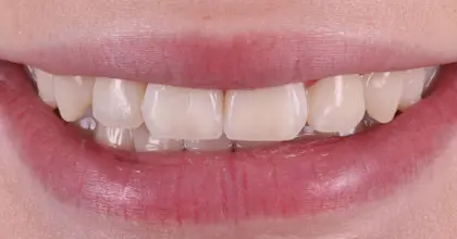 Vogue Dental - Teen Invisalign Case 2 After Smiling