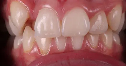 Vogue Dental - Teen Invisalign Case 2 Before Retracted