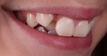 Vogue Dental - Teen Invisalign Case 2 Before Side