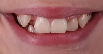 Vogue Dental - Teen Invisalign Case 2 Before Smiling