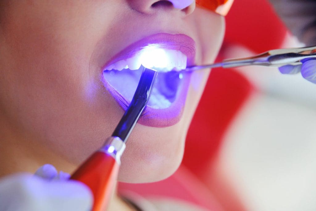 Dental Fillings Bexleyheath