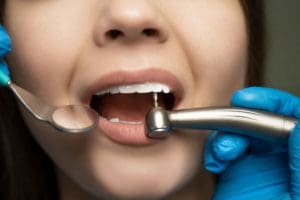 How Long Does a Root Canal Last?