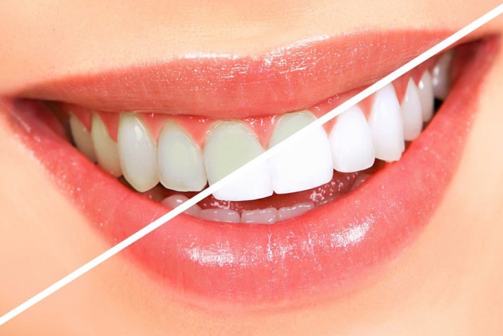 Professional Teeth Whitening Bexleyheath