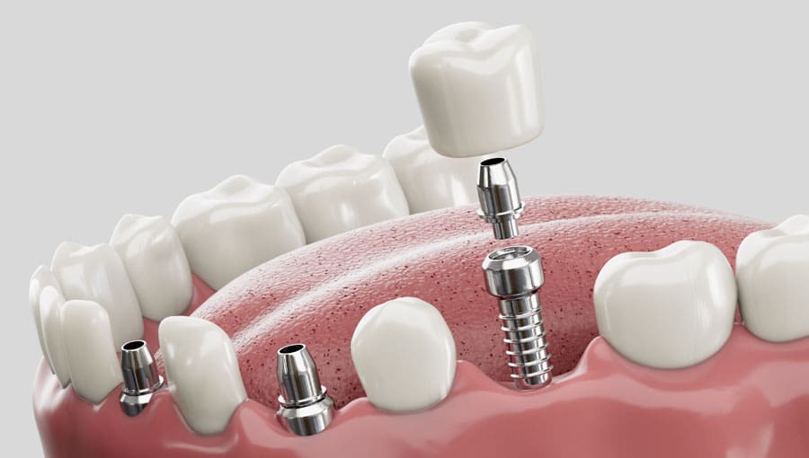 Vogue Dental - Dental Implant
