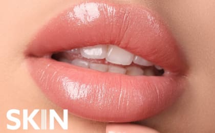 Skin@VogueDental - Lip Filler Treatment