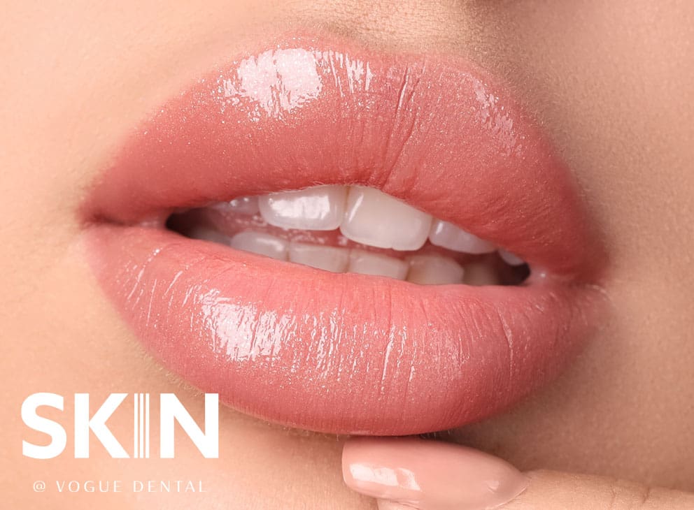 Skin@VogueDental - Lip Filler Treatment