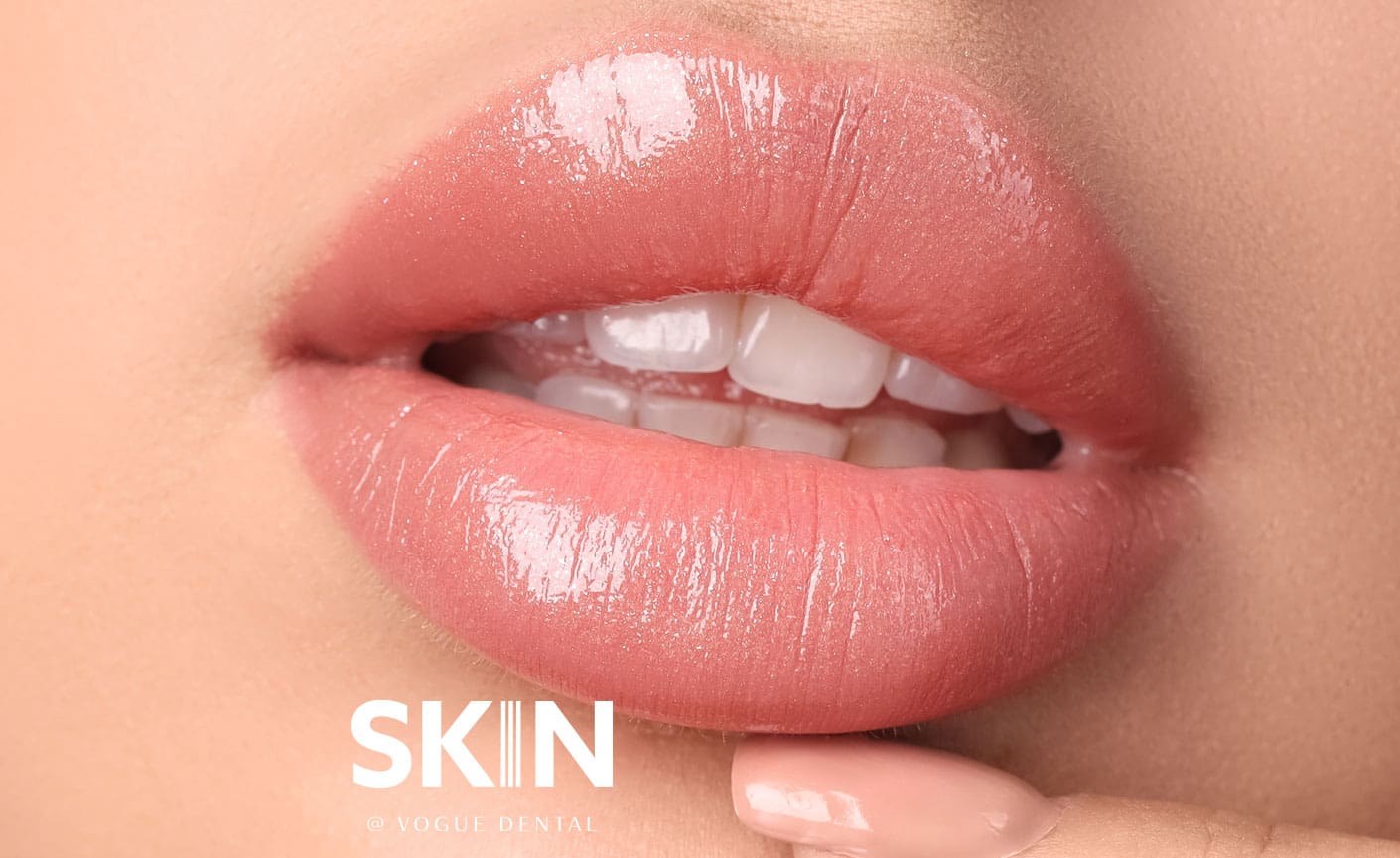 Skin@VogueDental - Lip Filler Treatment